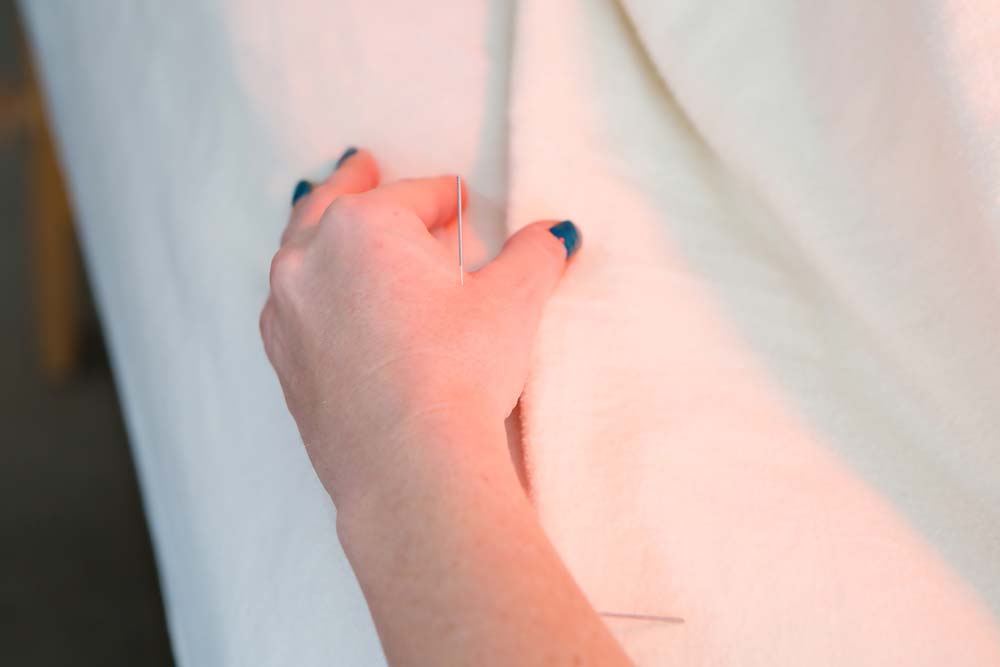 acupuncture neurology1